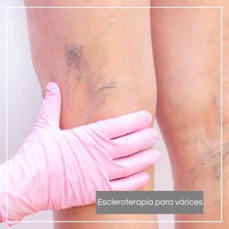 Sclerotherapy for varicose veins