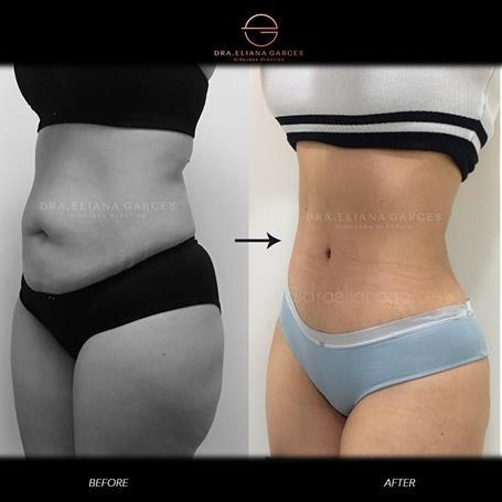 Tummy tuck