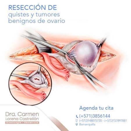 Ovarian cyst resection
