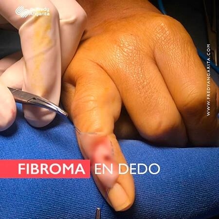 Finger fibroma