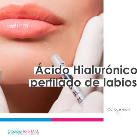 Hyaluronic acid  for lip contouring