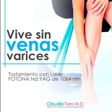 Treatment for varicose veins