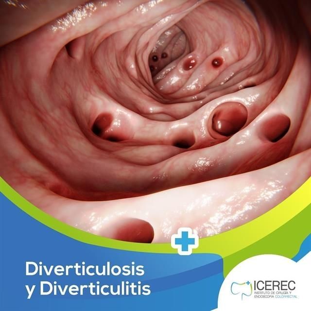 Diverticulosis and diverticulitis
