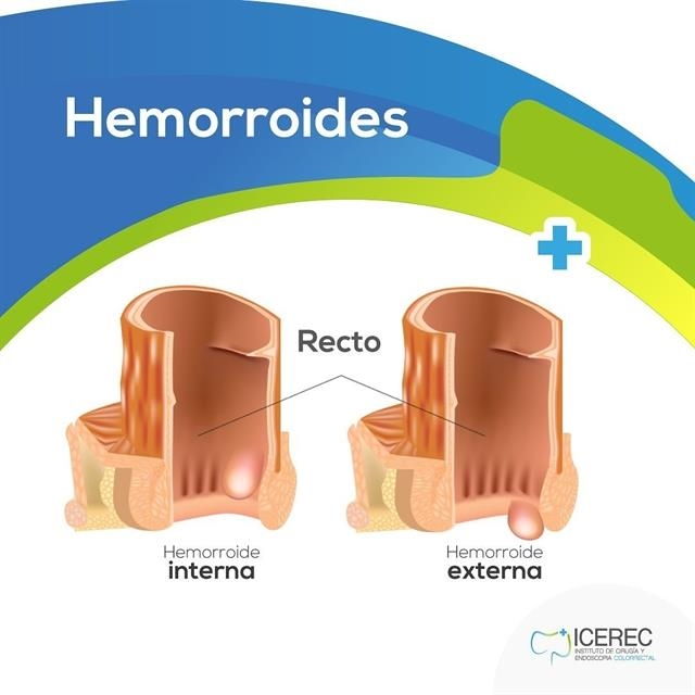 Hemorrhoid treatment without pain
