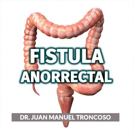Fistula anal