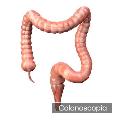 Colonoscopia 