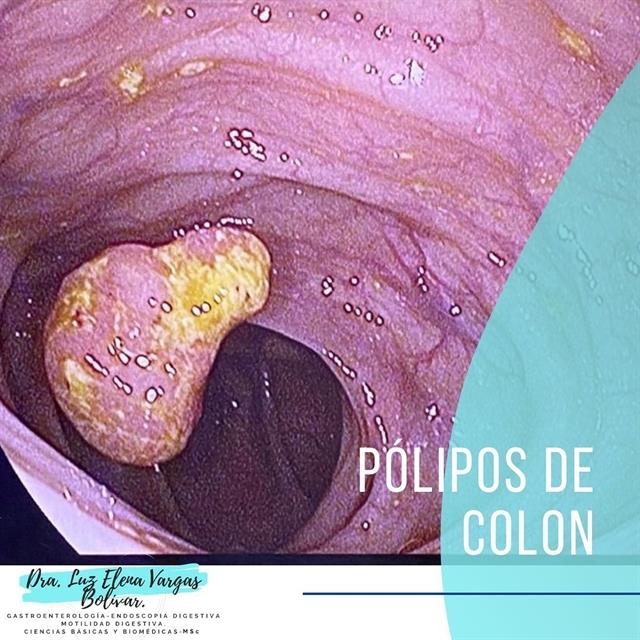 Pólipos de Colon 