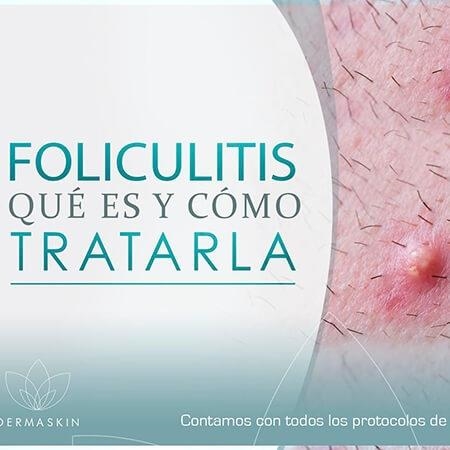 Foliculitis 