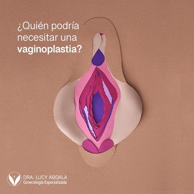 Vaginoplastia 