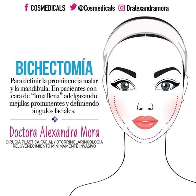 Bichectomia