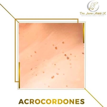 Acrocordones