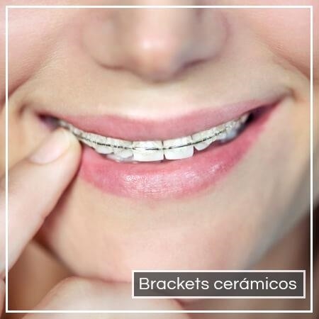  Ceramic braces
