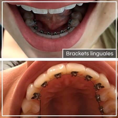 Brackets linguales