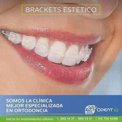 Aesthetic braces
