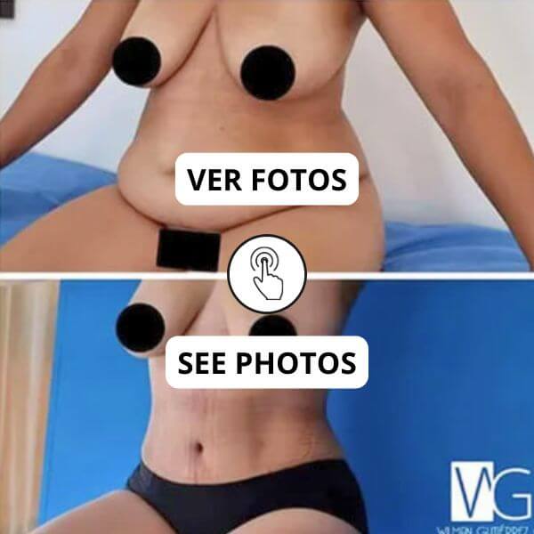 Tummy Tuck