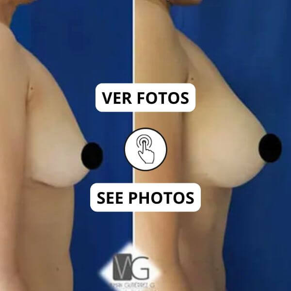 Breast Implant Surgery