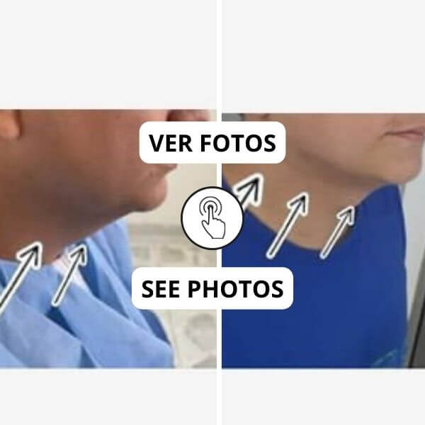 Bichectomy
