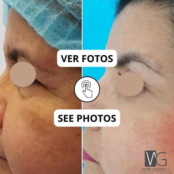 Eyelid Surgery