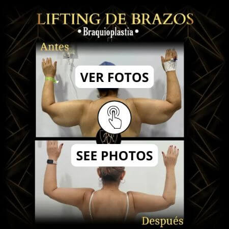 Arm Lift Surgery