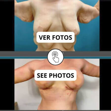 Post Bariatric Surgery