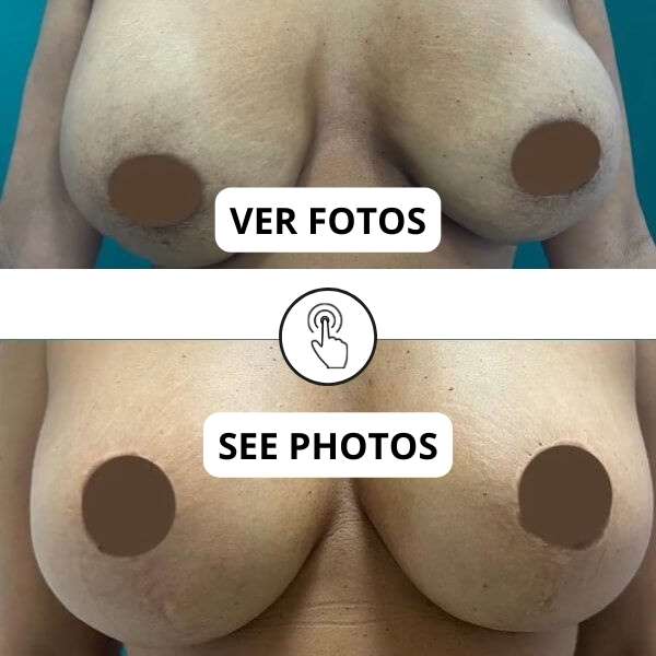 Breast Explant Surgery