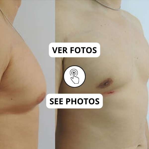 Male Breast Reduction