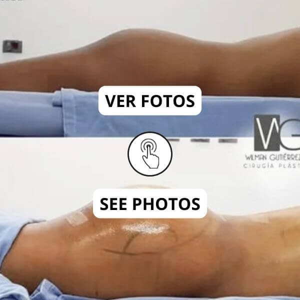 Buttock Surgery
