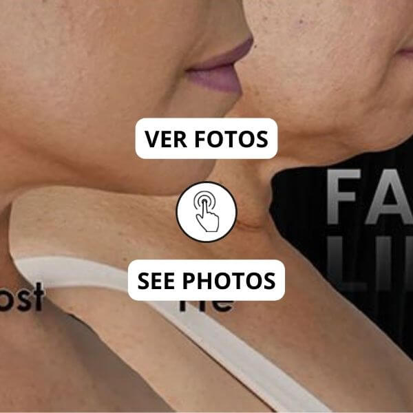 Neck and double chin lift