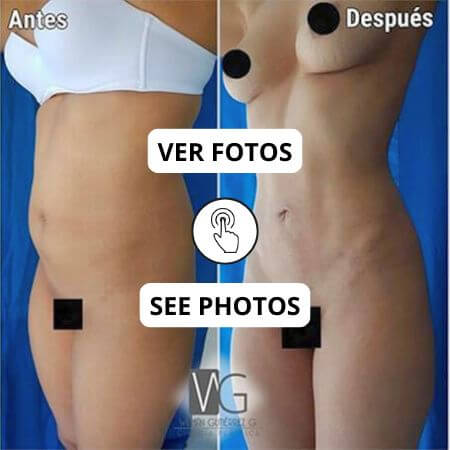 Liposculpture