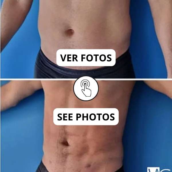 Male Liposuction