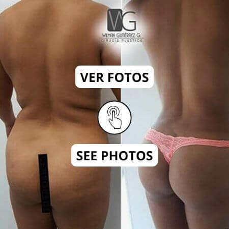 Brazilian Butt Lift BBL