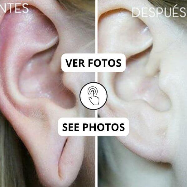 Lobuloplasty