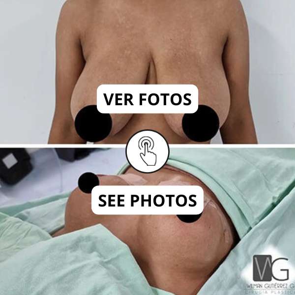 Breast Reduction