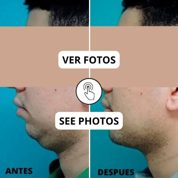 Chin Surgery