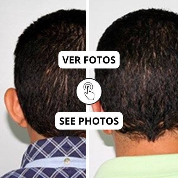 Otoplasty