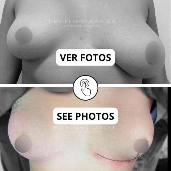Breast Reconstruction Surgery