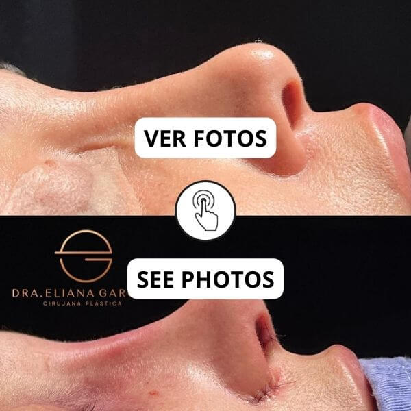 Nose Job