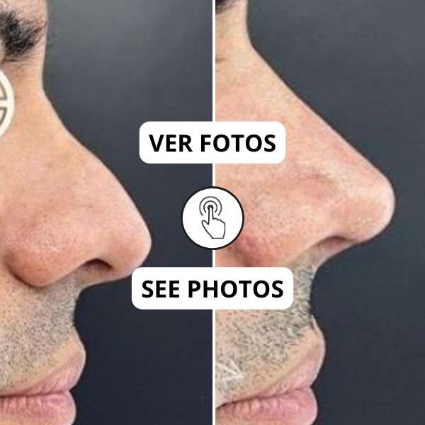 Masculine Nose Surgery