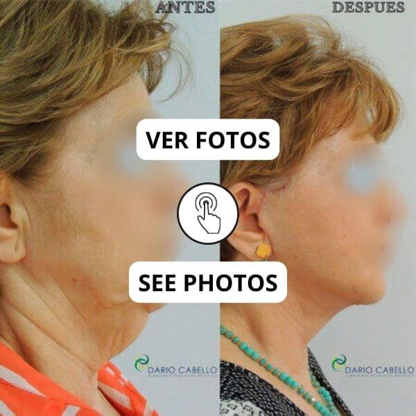 Facelift