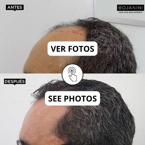 Hair Transplant