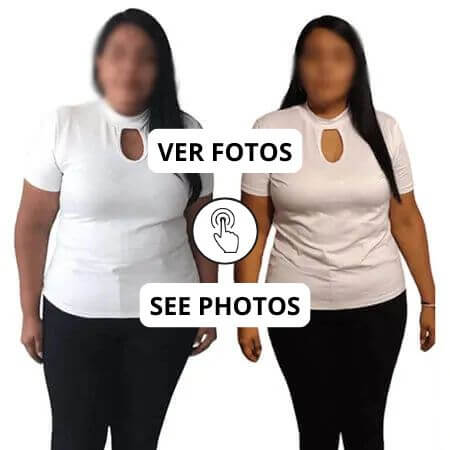 Gastric Sleeve