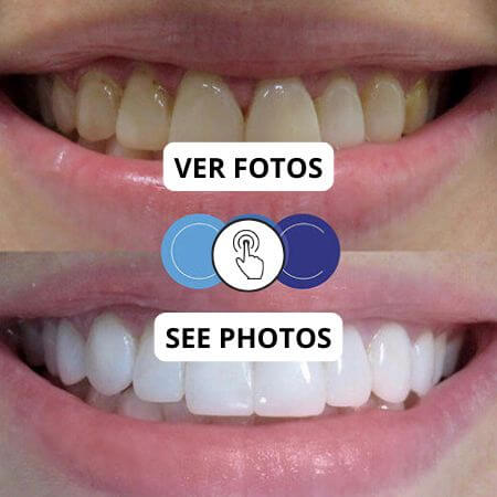 Blanqueamiento dental