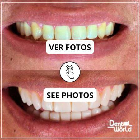 Carillas dentales