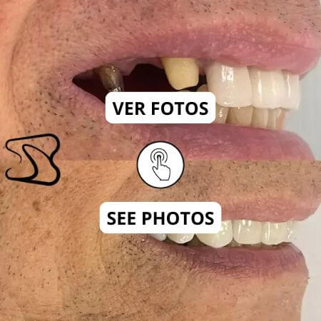 Corona dental