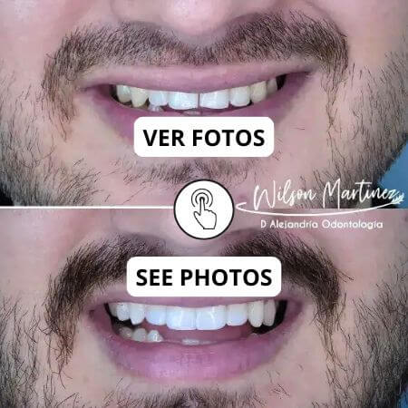Diseño de sonrisa