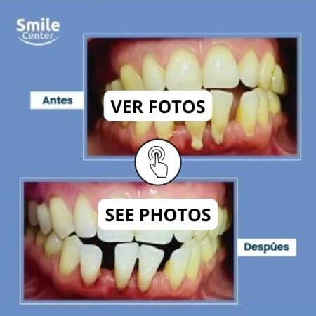 Cirugía periodontal