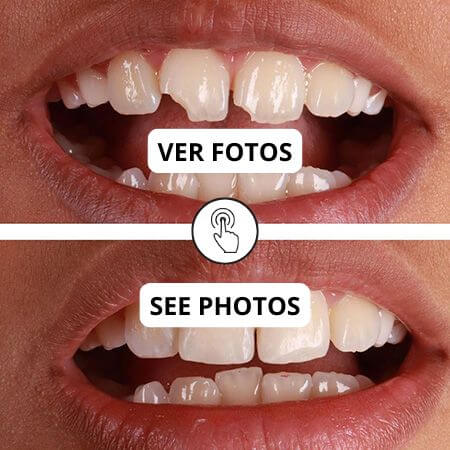 Fractura dental