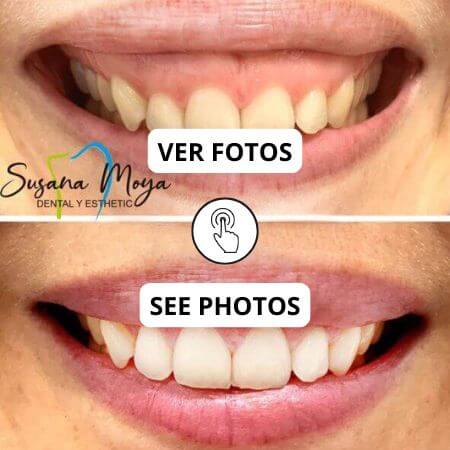 Gingivectomía
