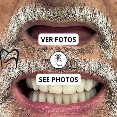 Implantes All on 4