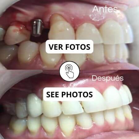 Implantes dentales